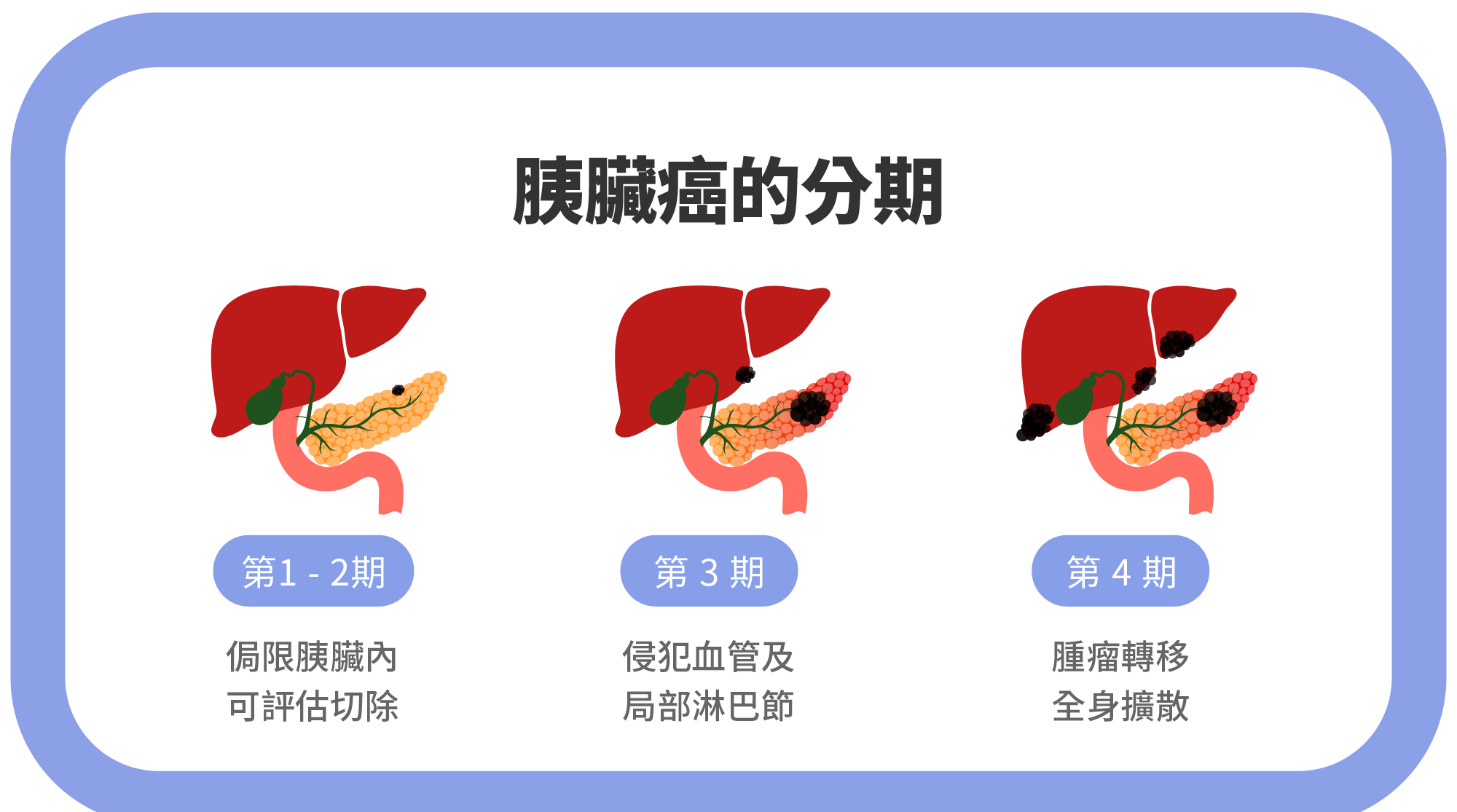 米蕈學會|胰臟癌指南:最新胰臟癌治療全解析:手術、標靶、免疫療法優缺點一次看