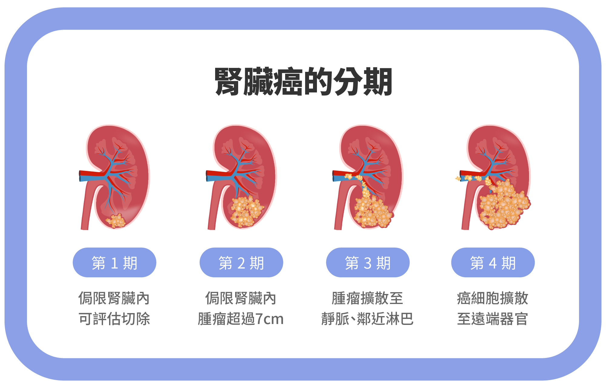 腎臟癌分期怎麼看?從第一期到第四期的存活率與治療選擇