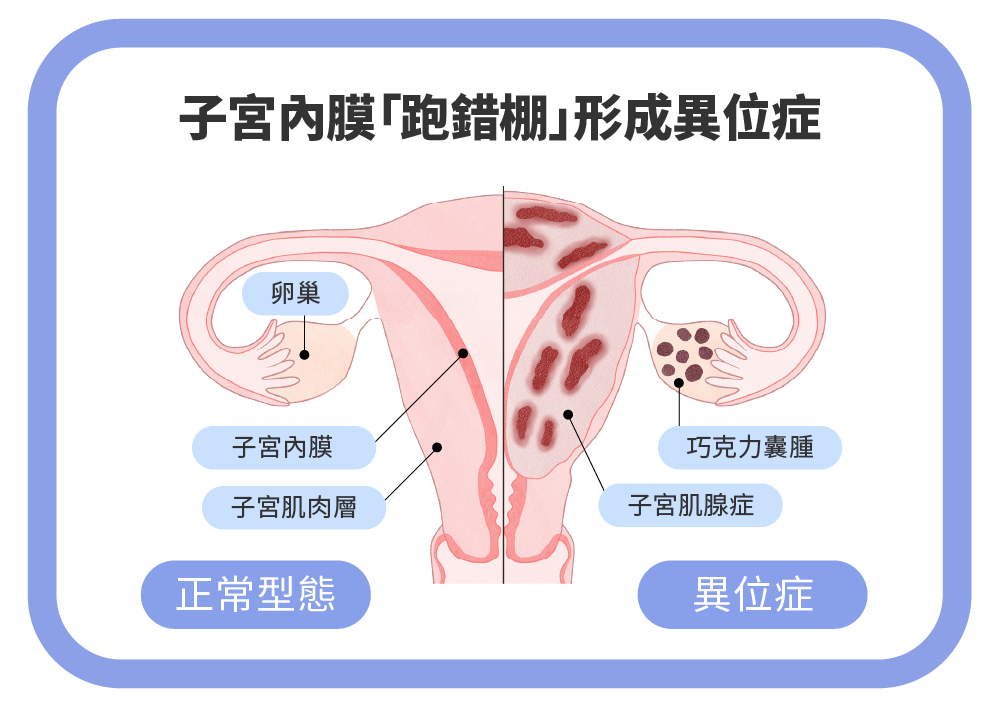 子宮內膜跑錯棚形成異位症
