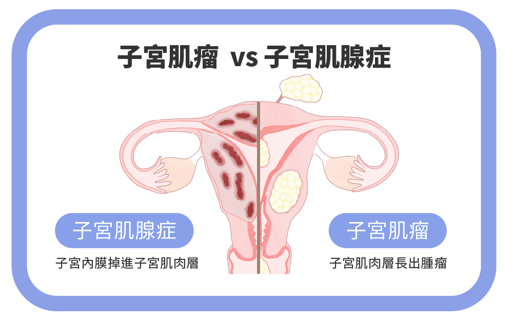 子宮肌瘤VS子宮肌腺症